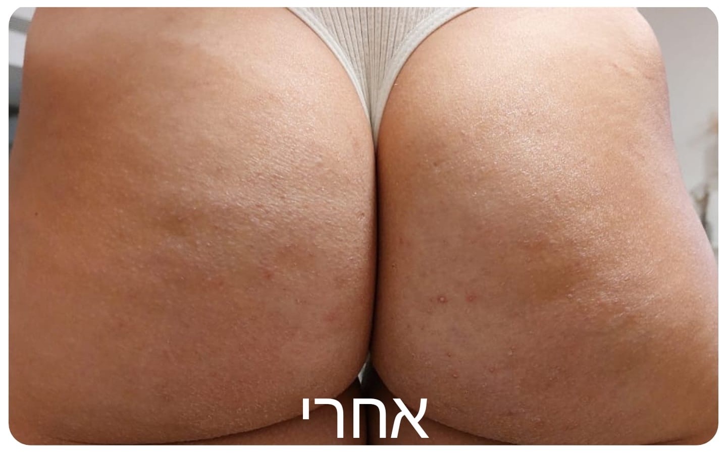 עור הישבן אחרי הטיפול