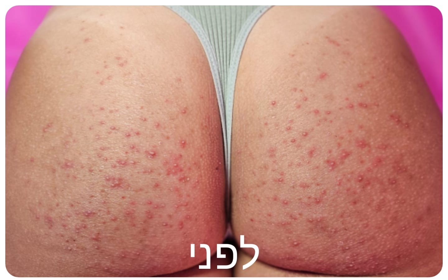 עור הישבן לפני הטיפול
