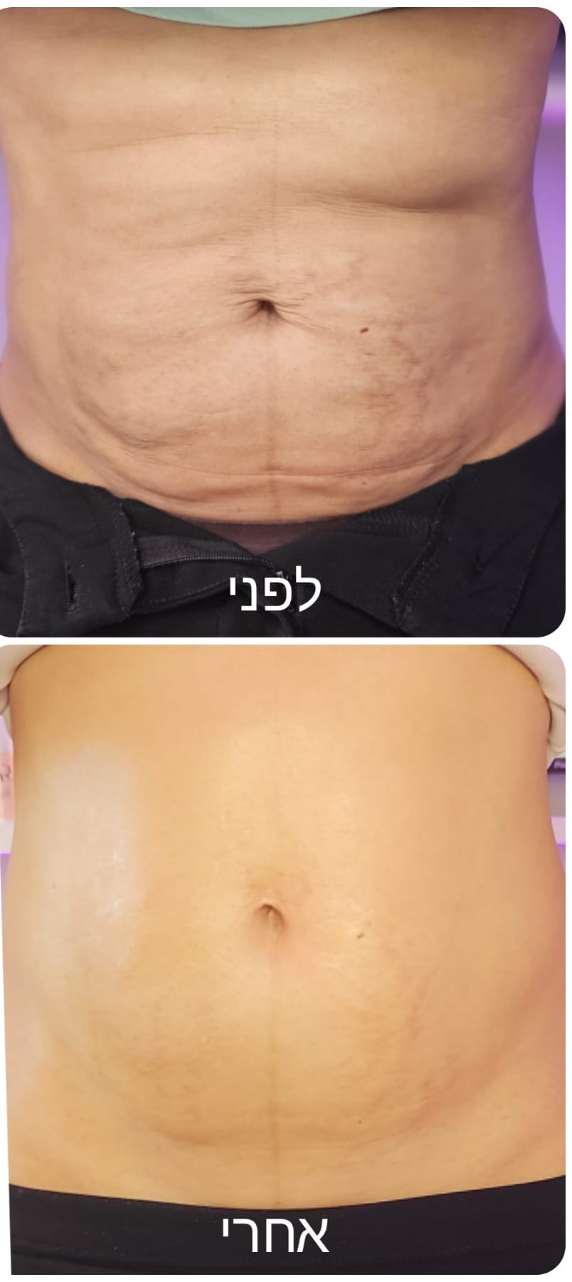שיפור סימני מתיחה בבטן לפני ואחרי